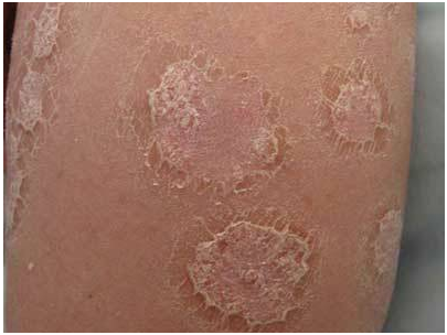 银屑病多久复发一次