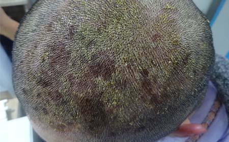 头部牛皮癣患者应该如何保护自己的头皮