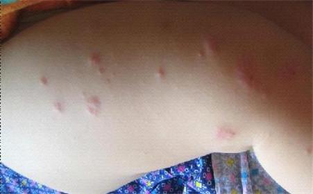 阻碍牛皮鲜的康复，竟是......