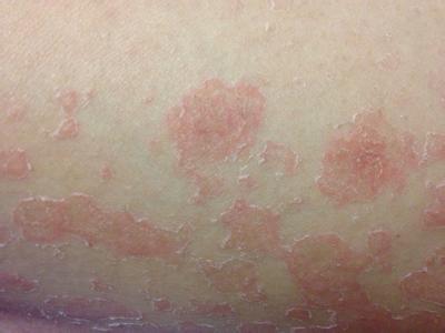 广州牛皮癣除了会影响患者的皮肤这些疾病患者也不能忽视