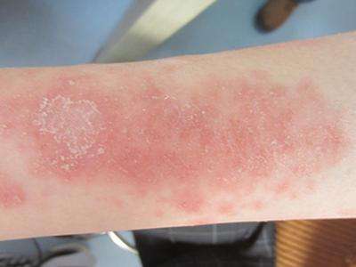 牛皮癣对患者有什么危害