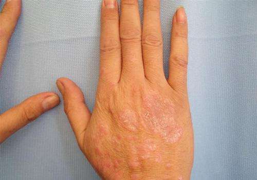 牛皮癣的发病原因知道哪些 牛皮癣的发病原因知道哪些