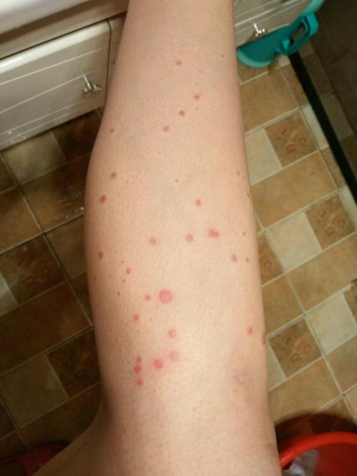 如何判断牛皮鲜康复了呢?标准是什么 如何判断牛皮鲜康复了呢?标准是什么