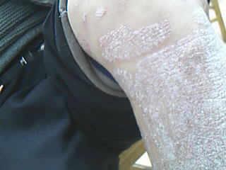 专家解答:为何男性牛皮癣患者比女性多 专家解答:为何男性牛皮癣患者比女性多