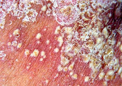 冬天在家牛皮癣患者应该如何预防复发