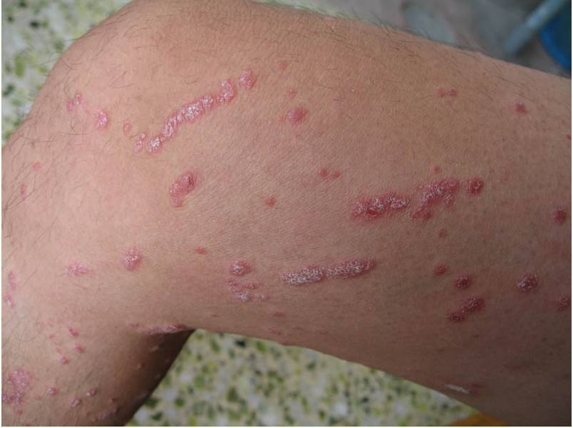 老年人患上牛皮癣饮食注意什么