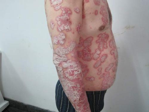 老年牛皮癣患者不能缺少关爱