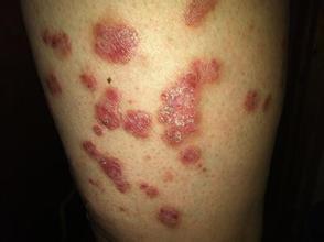 牛皮鲜久治不康复,原来问题全在这 牛皮鲜久治不康复,原来问题全在这