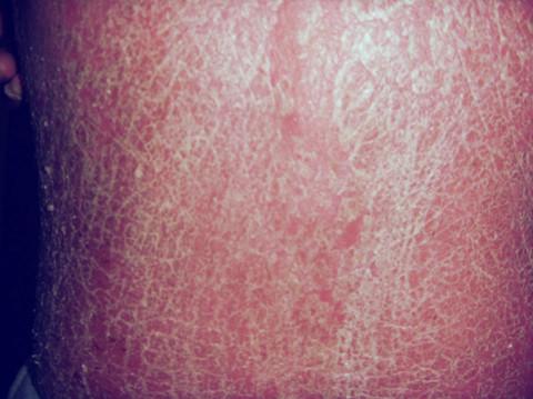 康复案例：享受治疗基金，摆脱牛皮癣